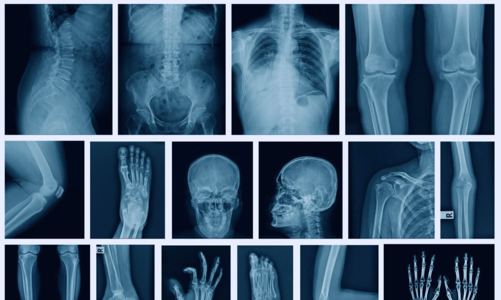 Revolutionizing Arthritis Trials with AI-Driven Imaging Biomarkers